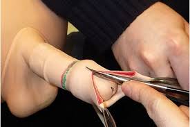 circoncision